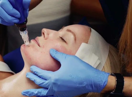 10% Off Microneedling Treatments
